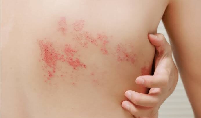 آلرژی به کلر استخر شنا چیست و چه علائمی دارد؟