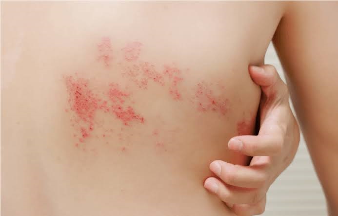 آلرژی به کلر استخر شنا چیست و چه علائمی دارد؟